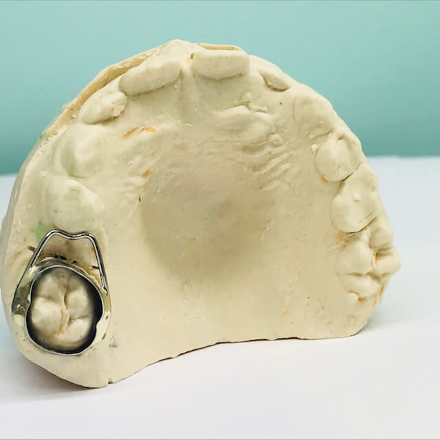 Распорка для зуба стационарная (Кольцо-петля)