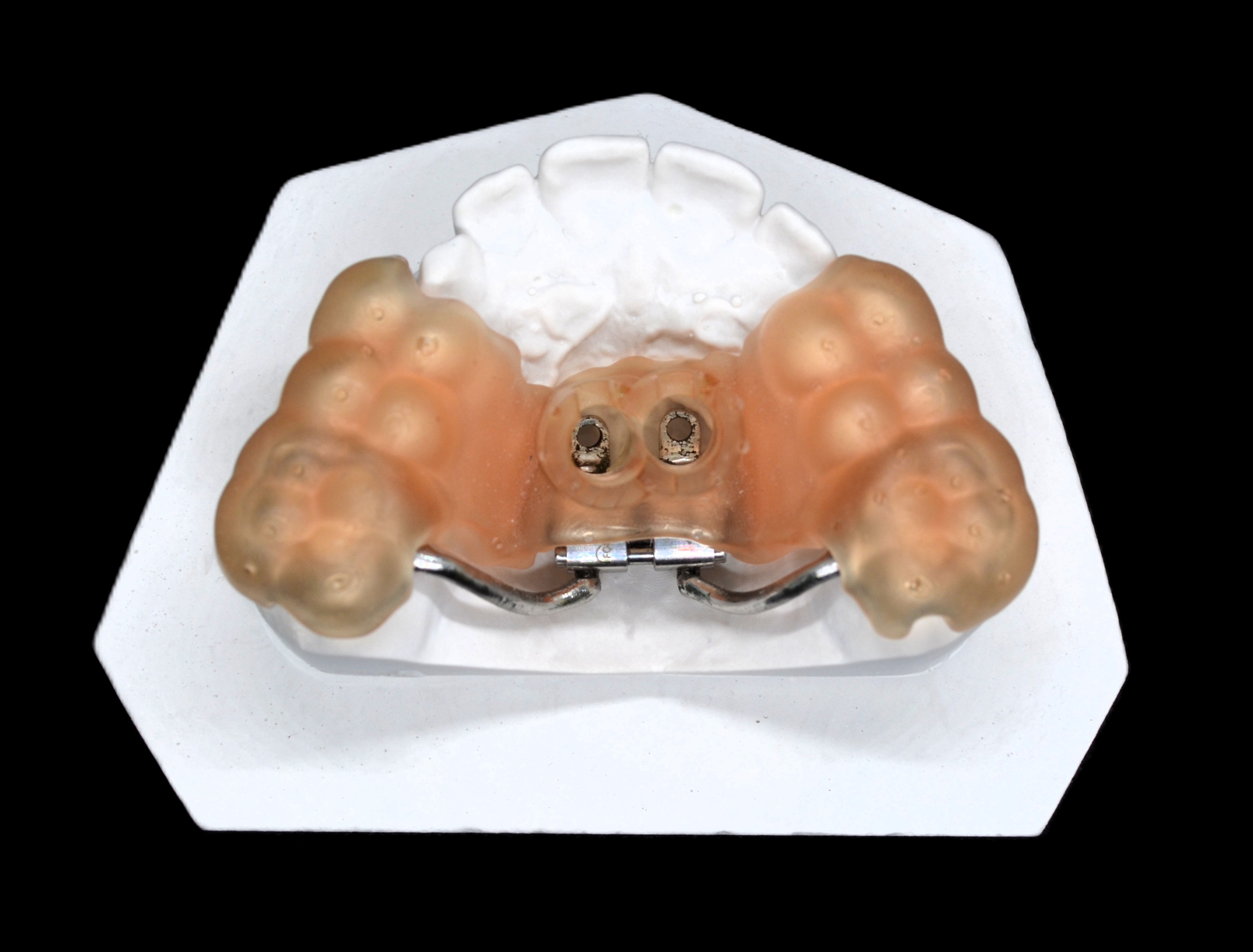 Аппарат на миниимплантах