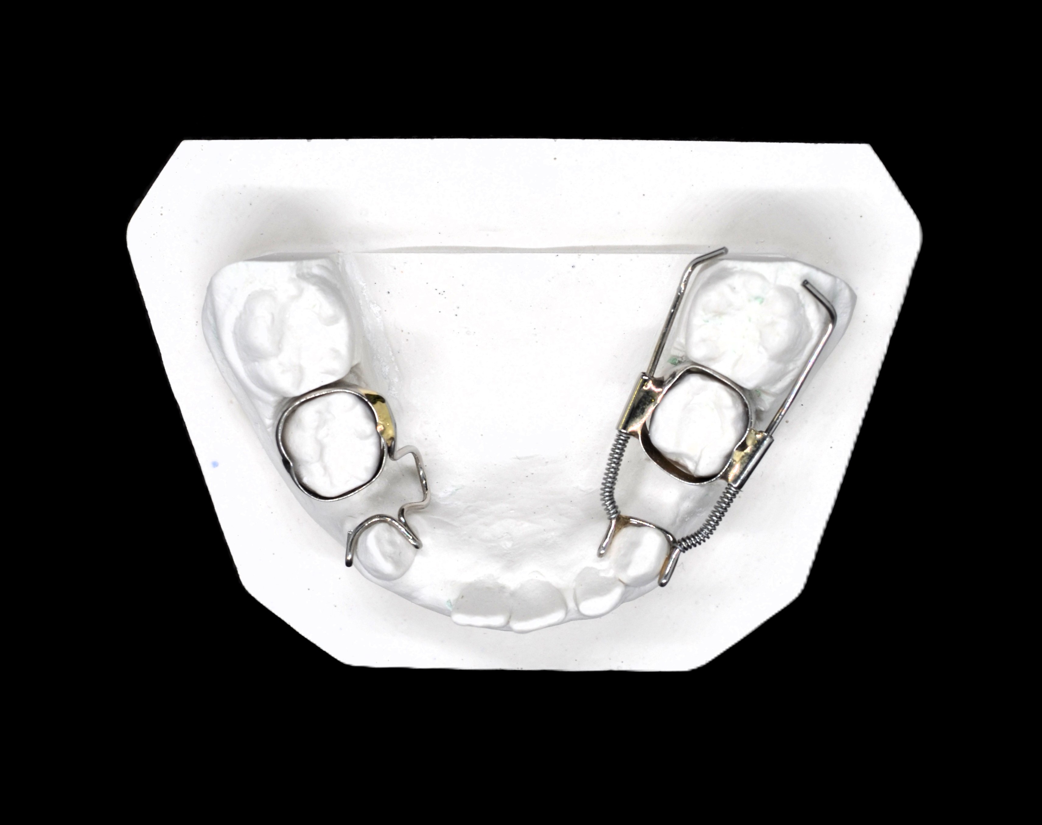 Распорка для зуба активная (с пружиной) на 1 кольце