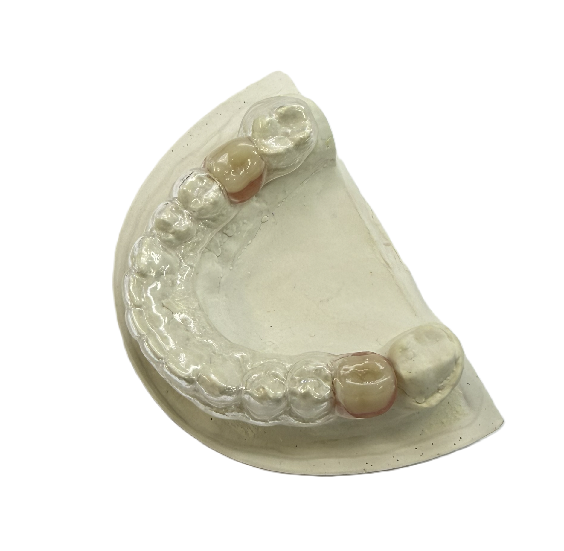 Установка в каппу 1 искусственного зуба