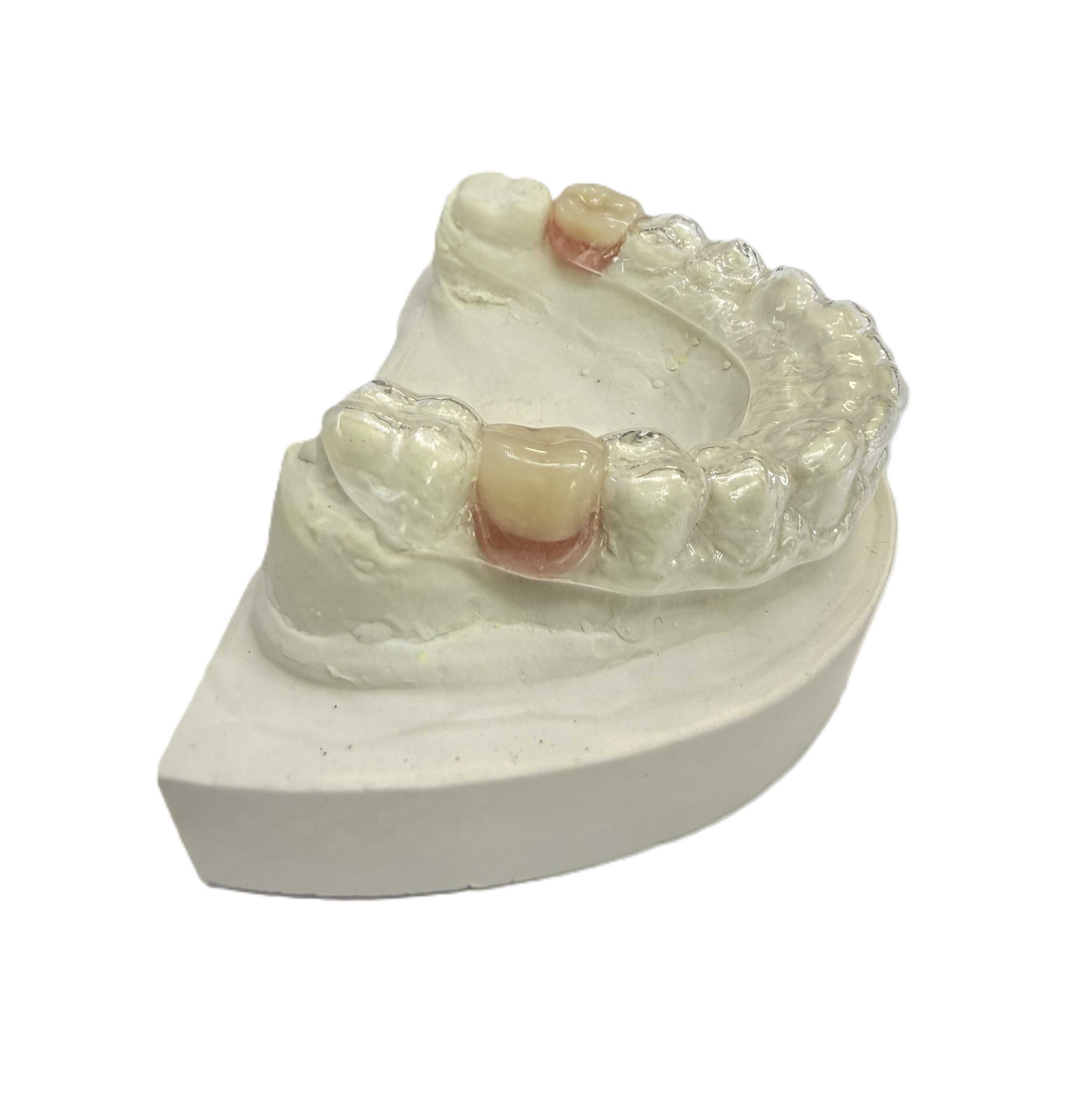 Установка в каппу 1 искусственного зуба